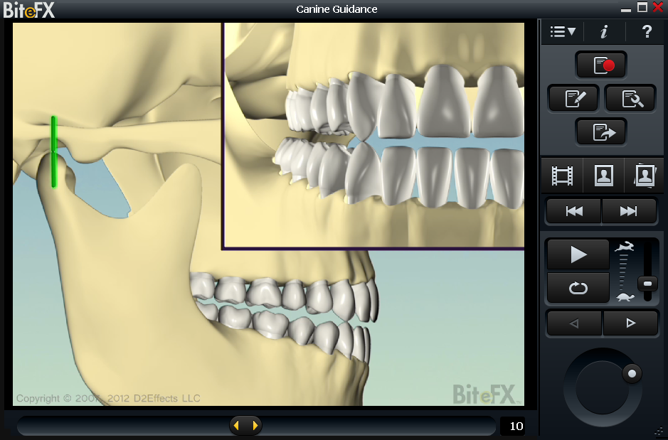 Dental case presentation showing canine guidance