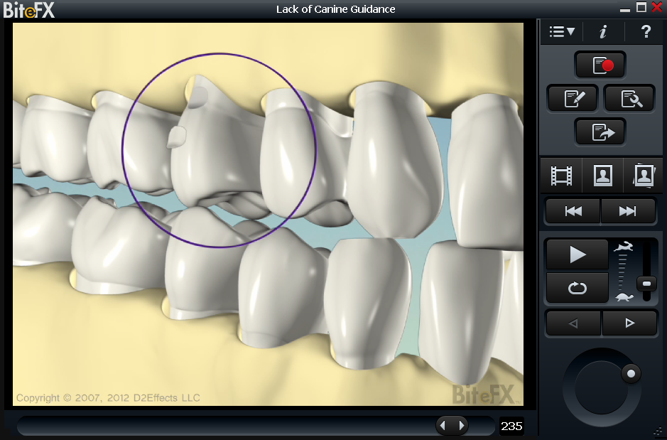 Dental case presentation showing lack of canine guidance