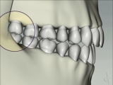 bruxing effect on molars