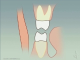 molars with-good anterior guidance