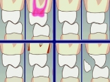 no anterior guidance effects on molars comparison