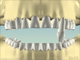 Interference between rear teeth