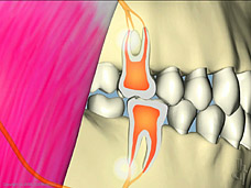 Occlusal disease with interference effects