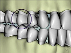 Occlusal disease with lack of canine guidance