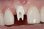 Implant Stage 8