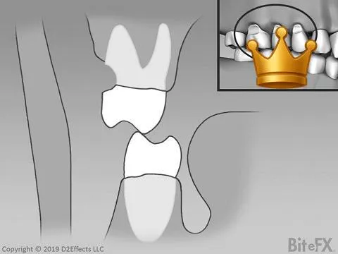 Abfraction FX (+inset)