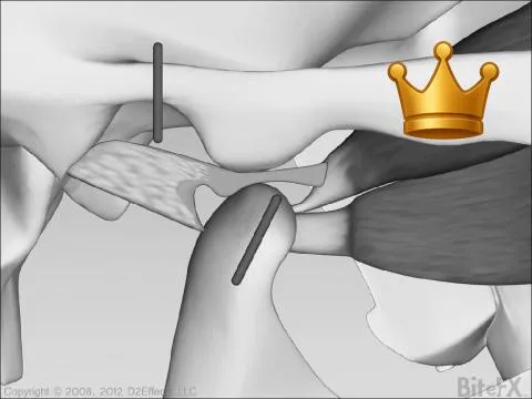 TMJ Disc Distortion V1
