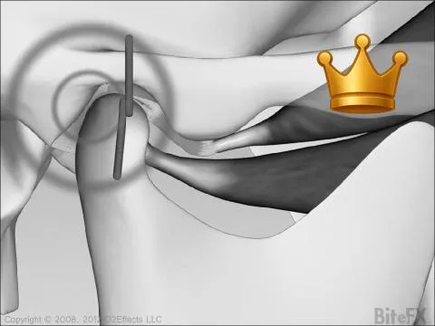 TMJ Disc Distortion V2