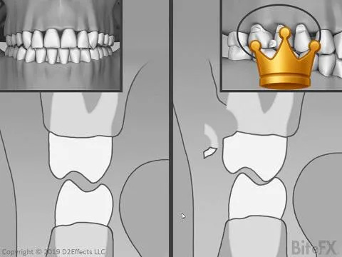 Abfraction Comp. (+inset)