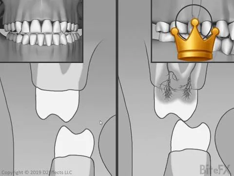 Nerve Comp. (+inset)