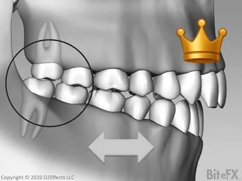 Brux Effect On Molar