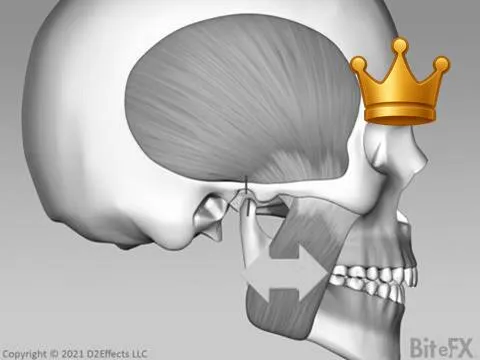 Brux Mscls Wide Angle