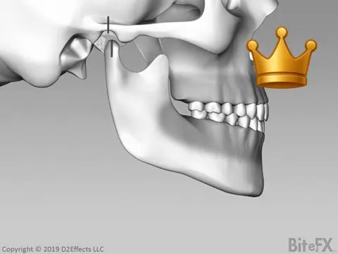 Dest: O-C No Muscles