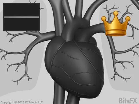 Plaque -> Heart Attack (Fatal)