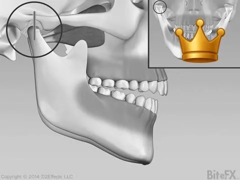 Fast Condyle Deterioration