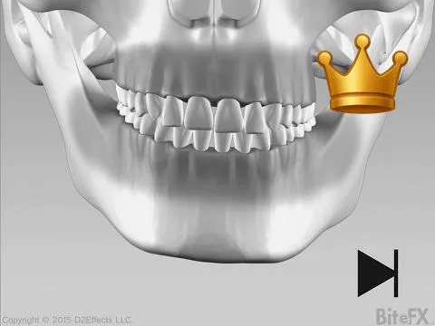 Slow Condyle Deterioration