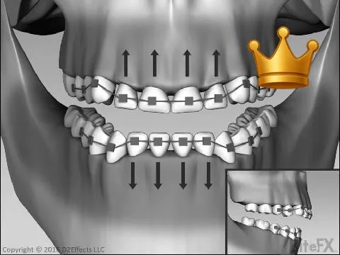 Correcting Supra Erupt