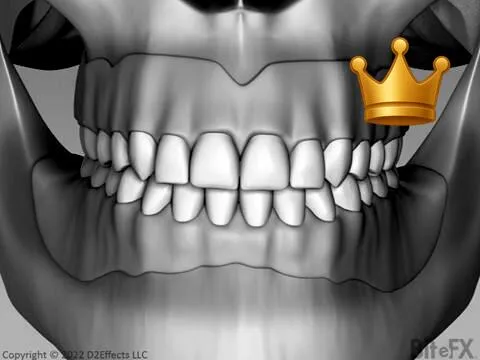 Dislodgement Top + Bottom