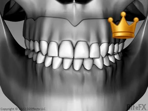 Dislodgement Top Only