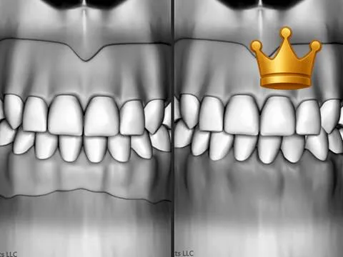 Dentures Dislodgement