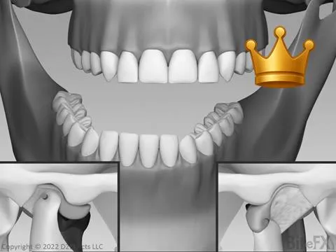 Disc off Front Block - FS
