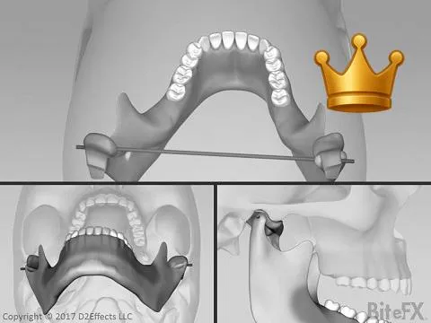 Disc Off Front Block