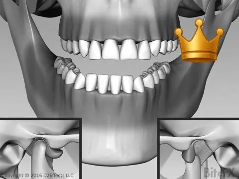 Slip Recap Front Sides