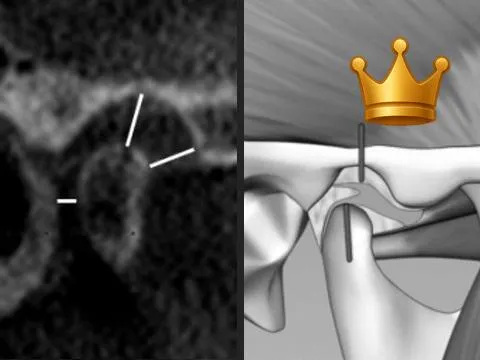 5CP: Retruded and Down