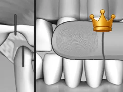 Fremitus Closure-NotCR