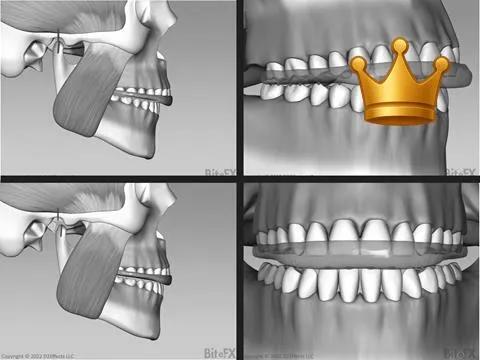 Full Splint - Details