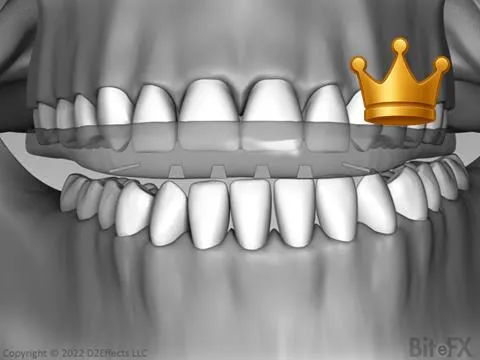 Full Splint with Traces
