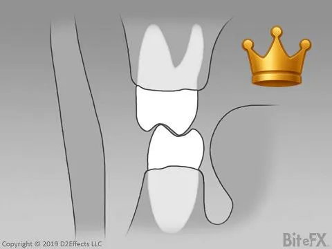 Molars With Guidance