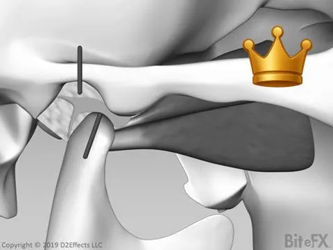 O-C Muscle Positioning