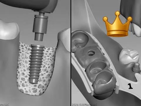 Implant + Impressions