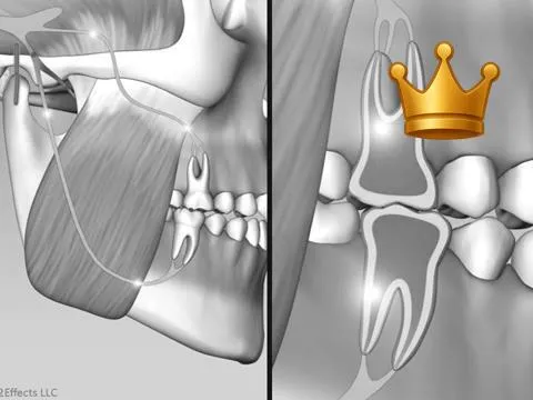 Int. Slide +Toothache