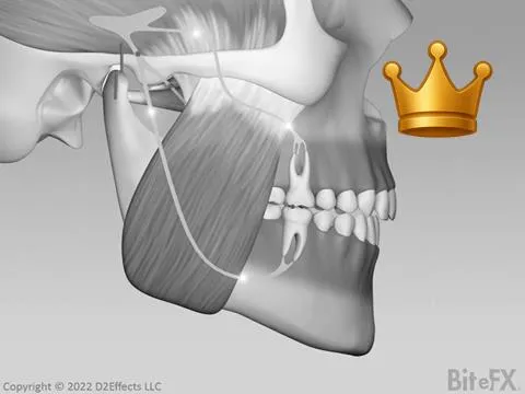 TMJ-Caused Interference Slide