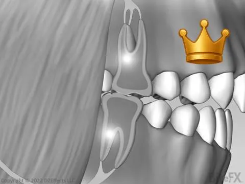 Interference Toothache