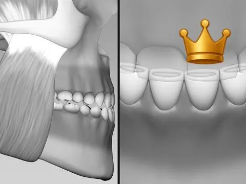 Interference Anterior Dest.