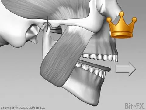 Lower Splint Removal