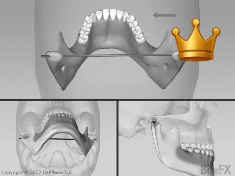 Mandibular Motions