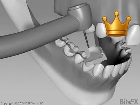 Onlay With Impressions