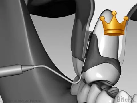 Periodontitis + Bad Bite