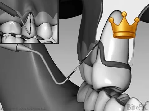 Recession and Gingiva V2