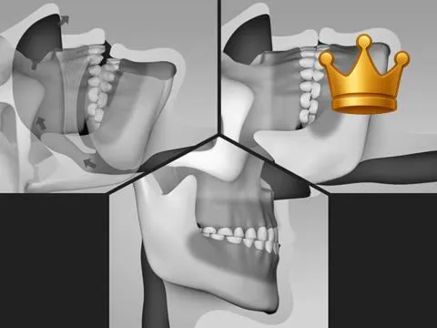 Wear from Rstrctd Airway
