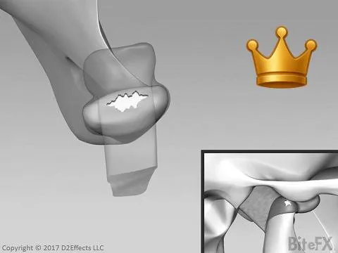 Retrodiscal Perforation