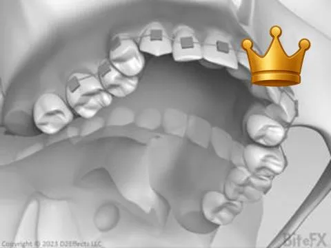 2nd Molar Missed Ortho