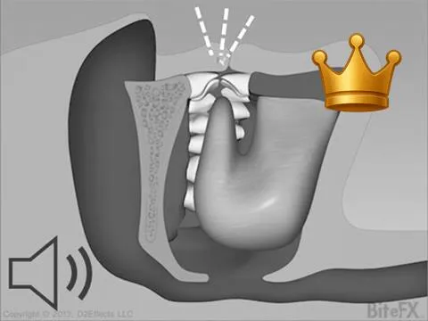 Sleep Apnea +Chipping