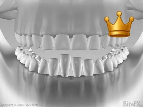 Supra Erupt of Anteriors