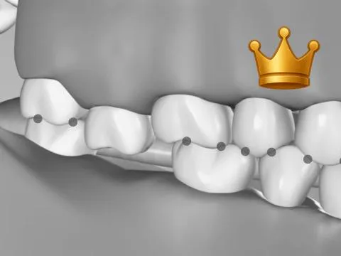 Supra Erupt of Posteriors