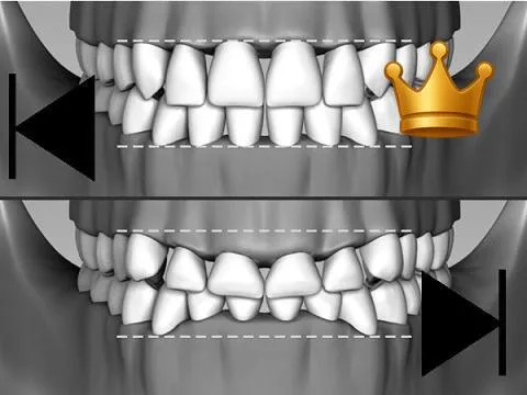 SupraE: Front Tooth Wear